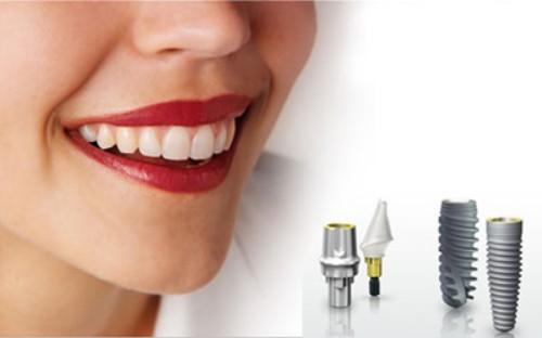 Bảng giá trồng implant