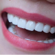 Khắc phục tình trạng răng bị thưa hiệu quả tại nha khoa Solar