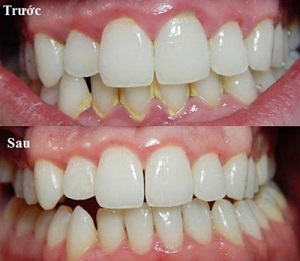 Tác hại của vôi răng, Cạo vôi răng có đau hay không
